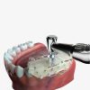 Surgical guide(dentis guide system) - Image 2