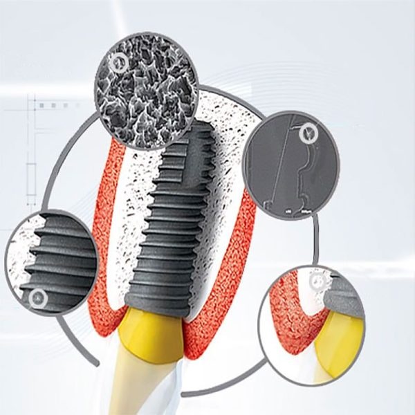 ایمپلنت دندانی